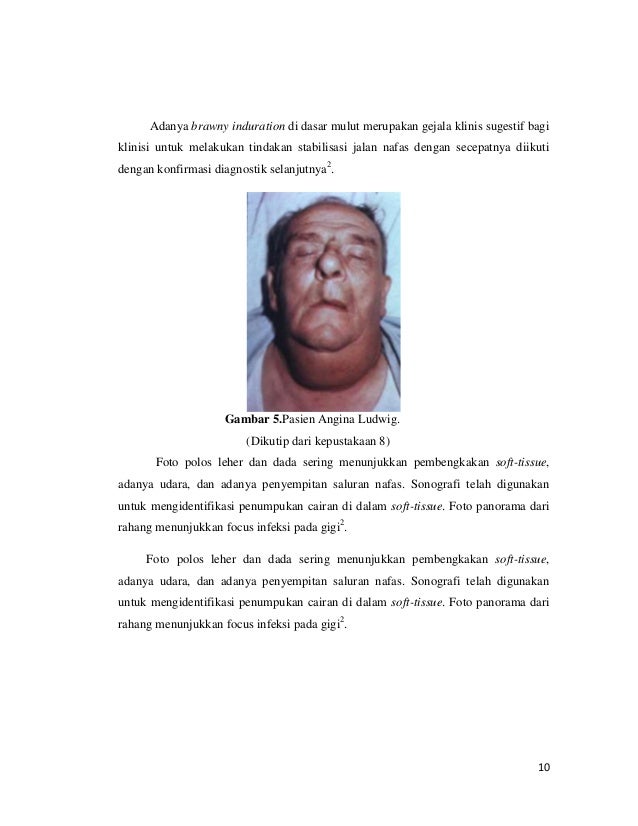 angina ludwig adalah